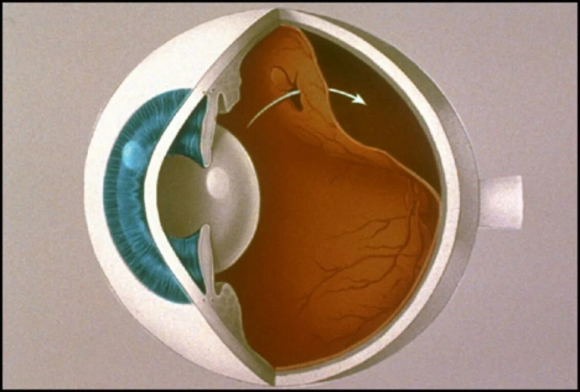 Отслойка сетчатки глаза. Отслойка сетчатки зрение. Экссудативная отслойка сетчатки. Задняя гиалоидная мембрана стекловидного тела.