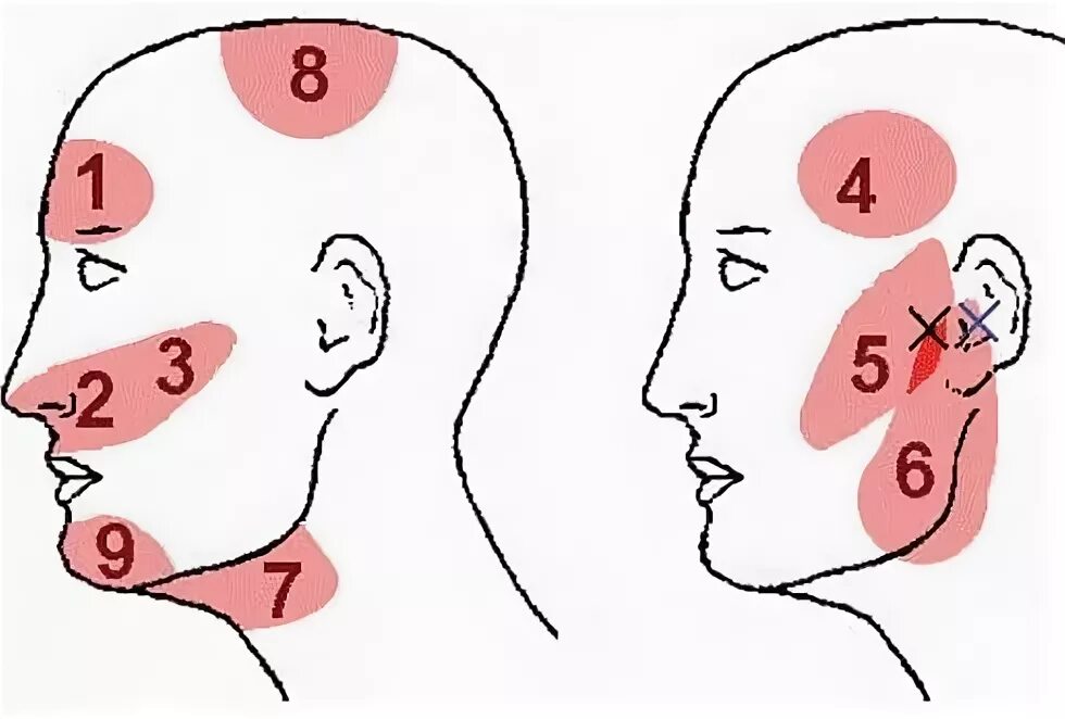 Болит под ухом при нажатии. Иррадиация болей в ухо и висок.
