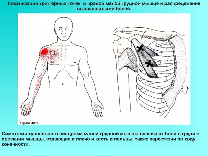 МФБС малой грудной мышцы симптомы. Миофасциальный синдром малой грудной мышцы. Туннельный синдром малой грудной мышцы синдром. Малая грудная мышца триггерные точки.