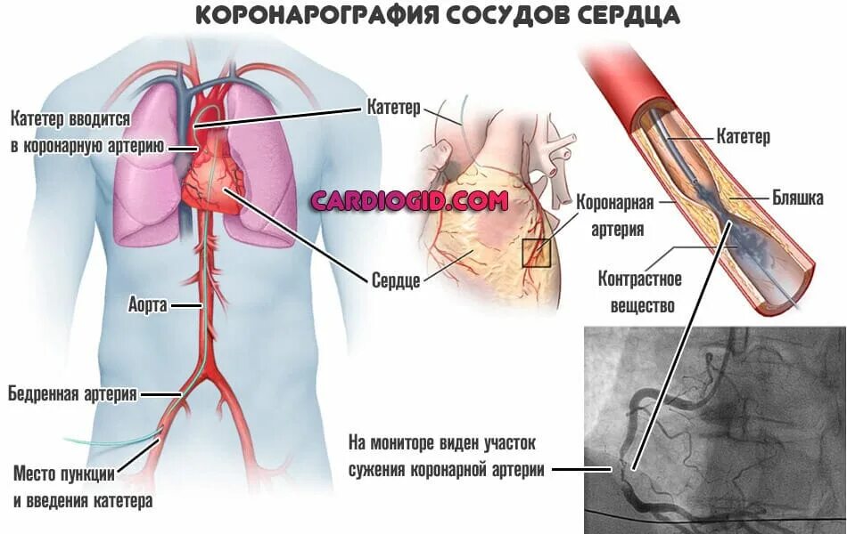 Коронарография сосудов сердца. Коронарография через бедренную артерию. Коронарография лучевой артерии. Метод проведения коронарография. Операция через сосуды