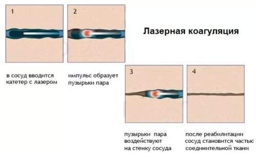 Лазерная деструкция геморроя. Лазерная коагуляция геморроя. Иссечение наружного геморроидального узла лазером. Лазерная вапоризация геморроидальных узлов. Лазерная коагуляция после операции