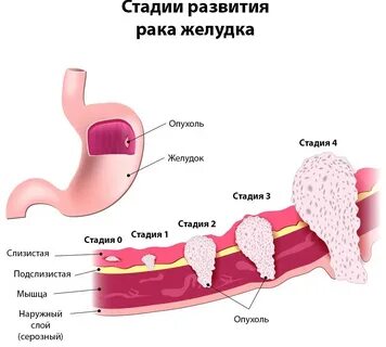 рак желудка 