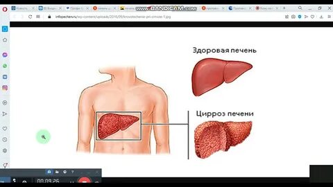 Вылечивается ли цирроз