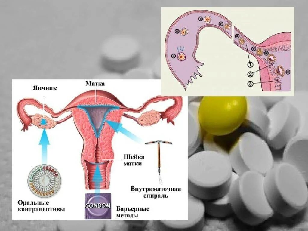 Гормональная контрацепция. Процесс овуляции. Таблетки чтобы не забеременеть. Оральные и внутриматочные контрацептивы. При приеме противозачаточных овуляция