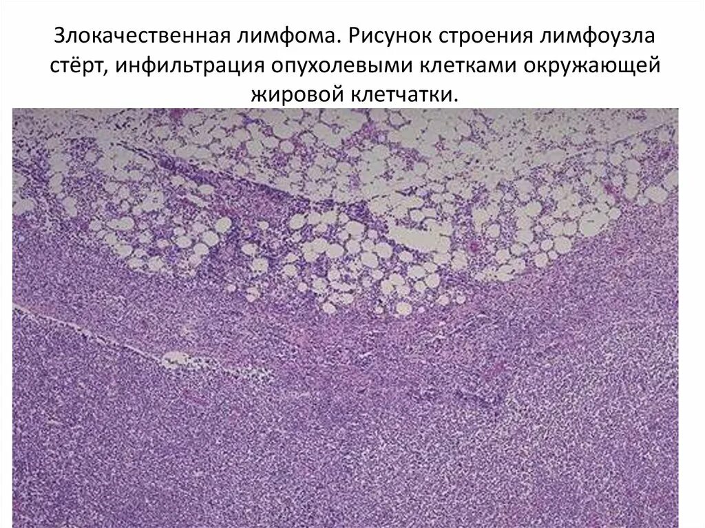 Инфильтрация в гистологии
