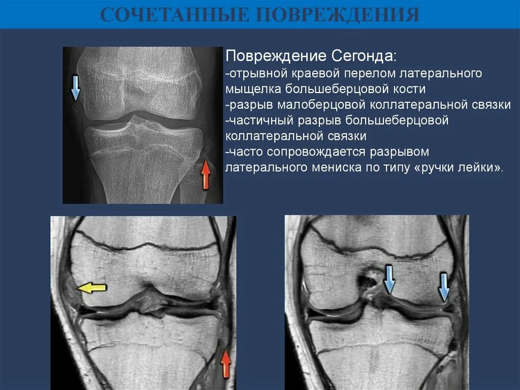 Латерального мыщелка большеберцовой кости. Краевой перелом латерального мыщелка. Краевой перелом мыщелка большеберцовой кости. Краевой перелом наружного мыщелка большеберцовой кости. Краевой перелом латерального мыщелка большеберцовой кости.