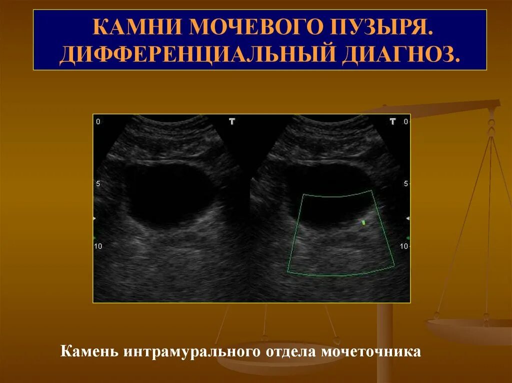 Интрамуральный мочеточник. Камень в интрамуральном отделе мочеточника. Камень мочевого пузыря дифф диагностика. Камень в мочевом пузыре дифференциальная диагностика.