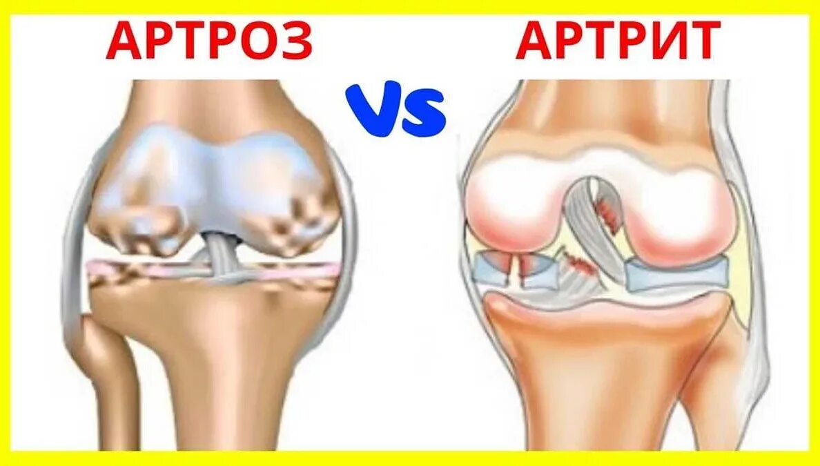 Артрит и артроз разница. Разница между артритом и артрозом коленного. Артроз или артрит коленного сустава разница.