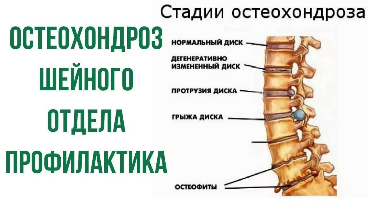 Хондроз шейного отдела позвоночника симптомы. Остеохондроз. Остеохондроз отдела позвоночника. Остеохондроз шейного отдела позвоночника. Профилактика остеохондроза.