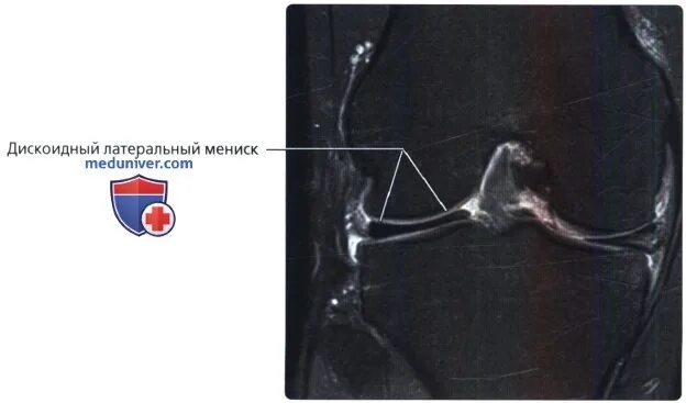 Разрыв мениска мрт. Дискоидный латеральный мениск. Дискоидные мениски коленного мрт. Дискоидный мениск коленного сустава что это такое. Резекция дискоидного латерального мениска.