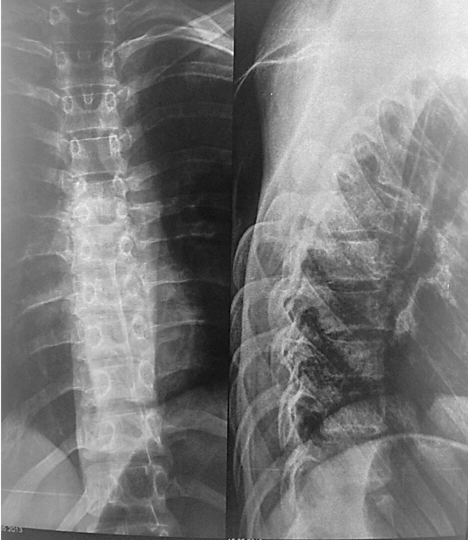 Перелом th5,th6 позвонка грудного отдела позвоночника. Перелом грудного отдела позвоночника рентген. Грудной отдел позвоночника рентген позвонки. Перелом позвонка грудного отдела рентген. Рентгенография позвоночника в 2 х проекциях