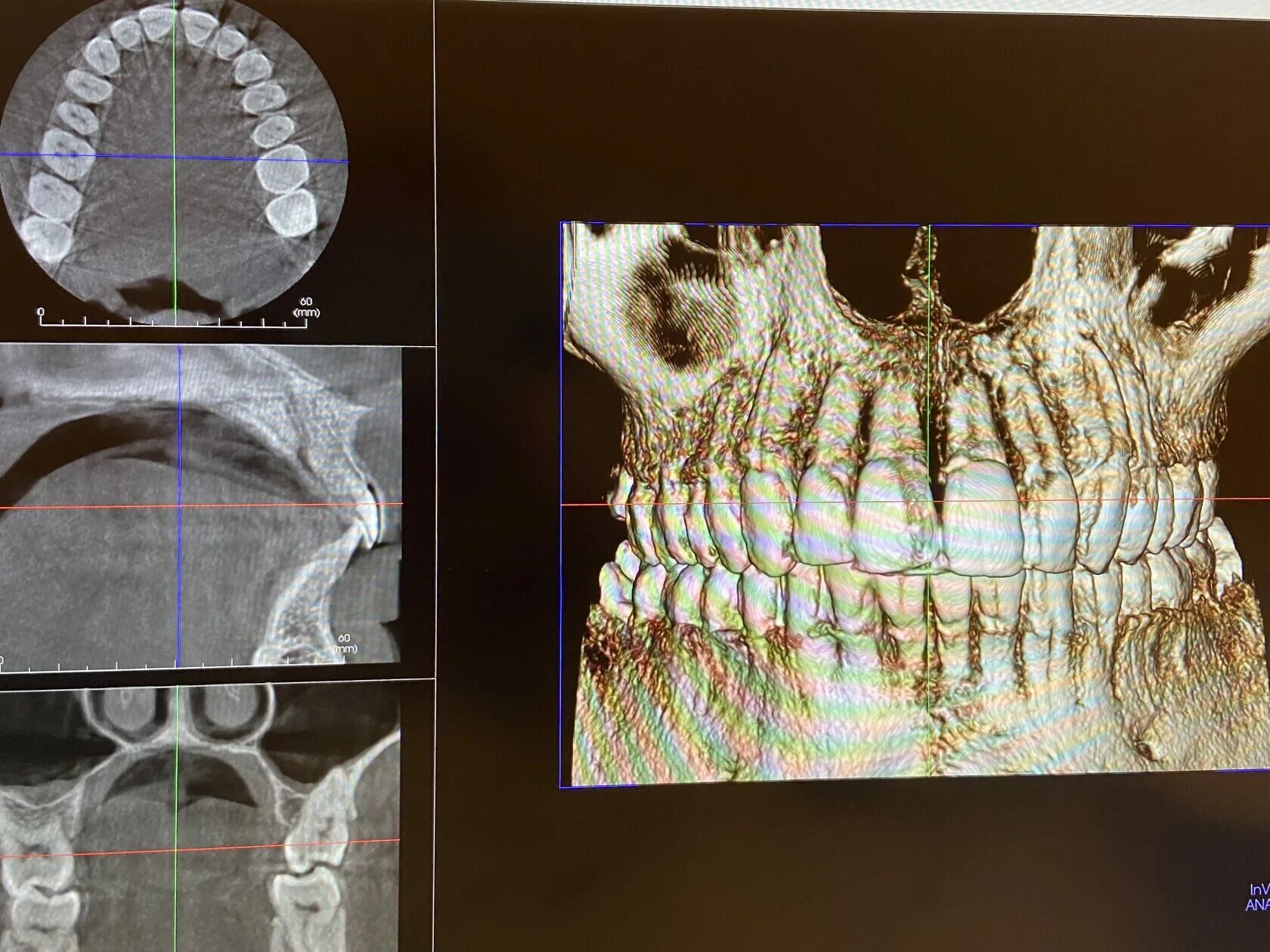 Где сделать кт зуба. Кт зубов. Компьютерная томография зубов 3d.