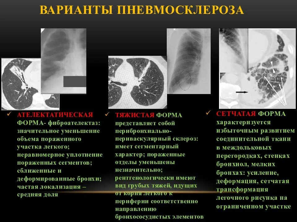 Диффузный пневмосклероз это рак. Пневмосклероз рентген описание. Постпневмонический фиброз на кт. Постпневмонический пневмосклероз. Диффузный сетчатый пневмосклероз.