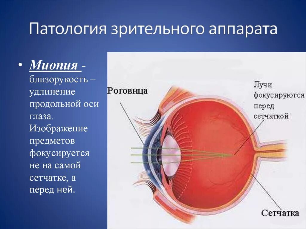 Близорукость строение глазного яблока. Анатомия глаза миопия. Строение глаза миопия. Анатомия глаза близорукость и дальнозоркость.