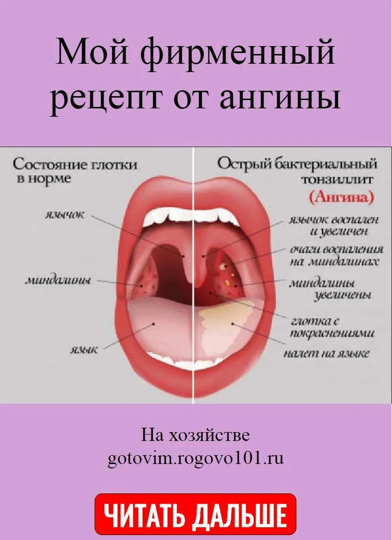 Острый тонзиллит катаральная форма. Лечение ангины гнойной у взрослых эффективные