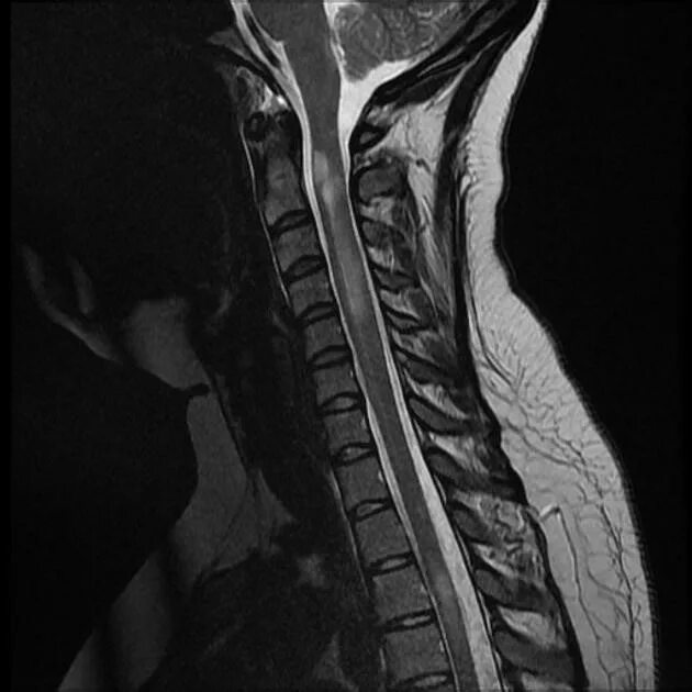 Эпендимома спинного. Мрт рассеянный склероз спинной мозг. Т1 т2 спинной мозг. Рассеянный склероз шейного отдела мрт. Очаги демиелинизации спинной мозг мрт.