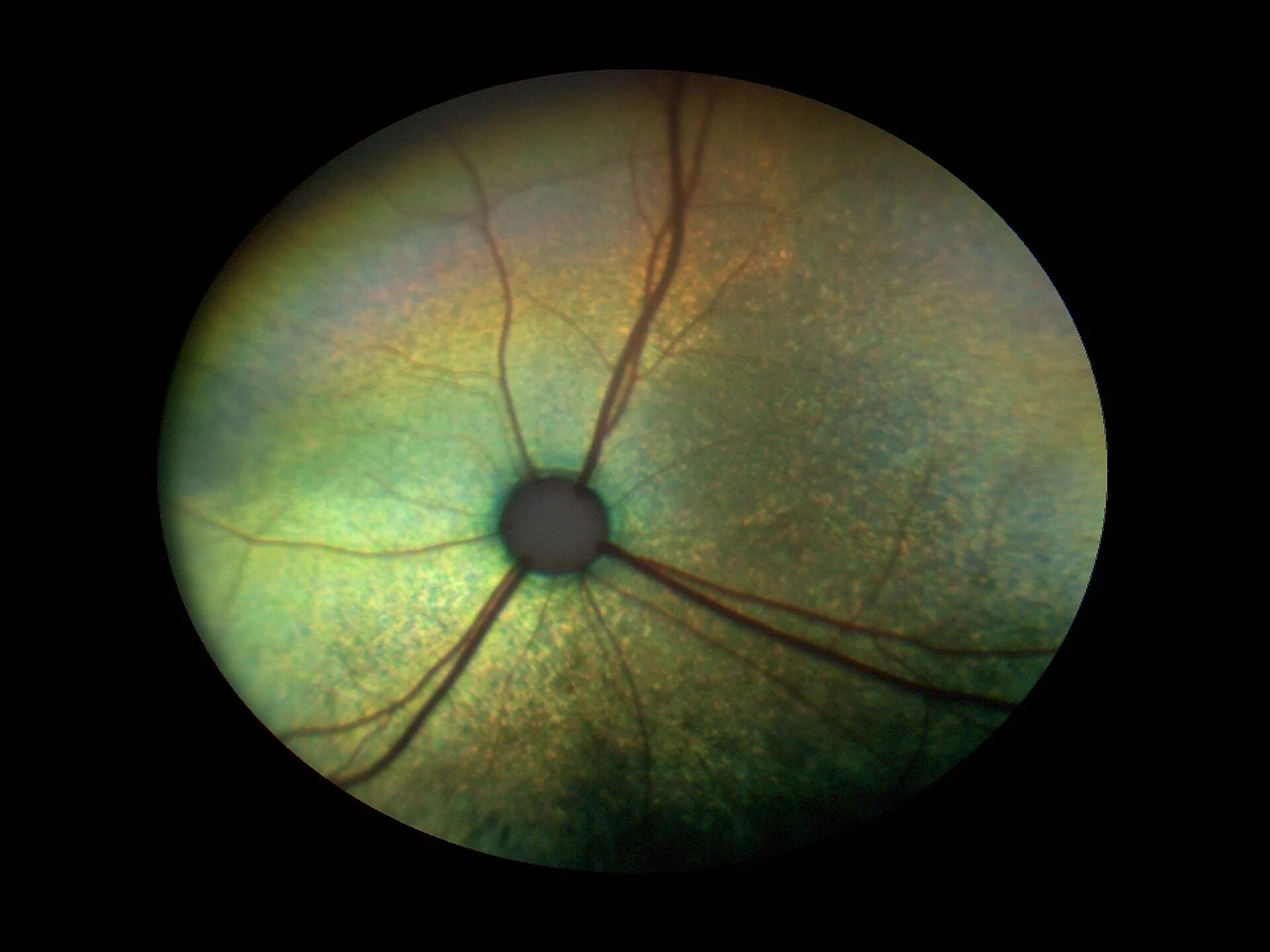 Отслойка сетчатки глаза офтальмоскопия. Отслойка сетчатки- атрофия сетчатки. Инееподобная дегенерация сетчатки. Дегенерация сетчатки у кошек. Центр сетчатки