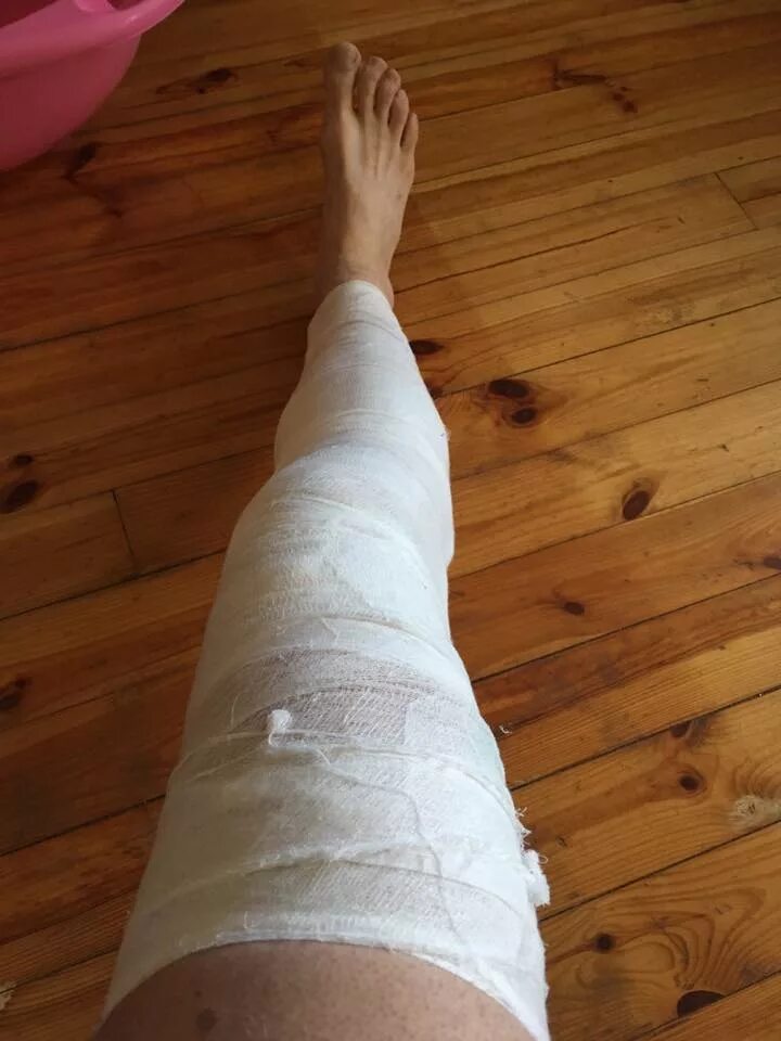 фото перевязанной