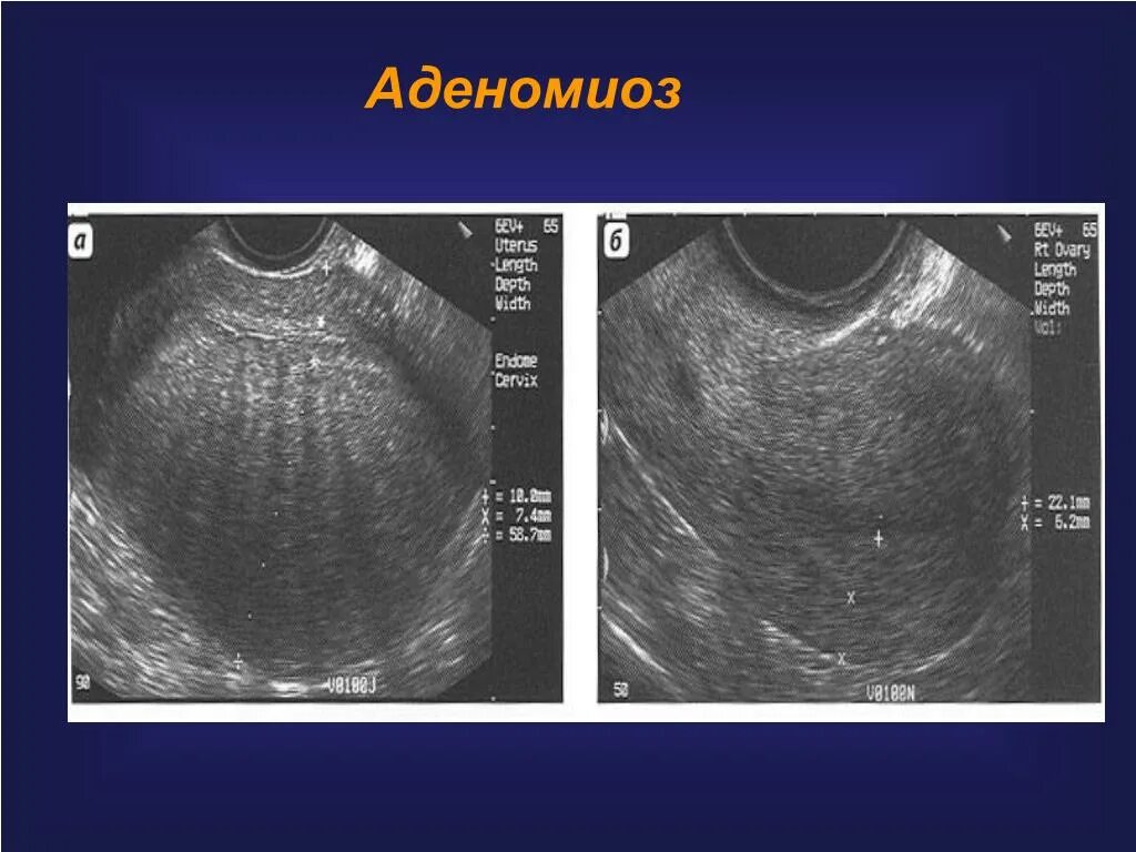 Эхопризнаки аденомиоза что это. Узловая форма аденомиоза матки на УЗИ. Диффузный эндометриоз матки УЗИ. УЗИ картина аденомиоз матки.