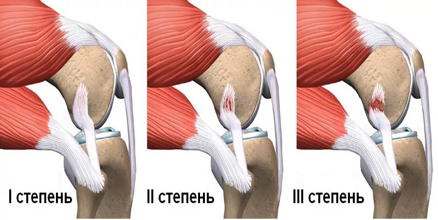 Обойтись разрыв. Внутрикапсулярные связки коленного сустава. Микроразрыв связок коленного сустава. Тендинит сухожилия подколенной мышцы. Ушиб подколенного сухожилия.