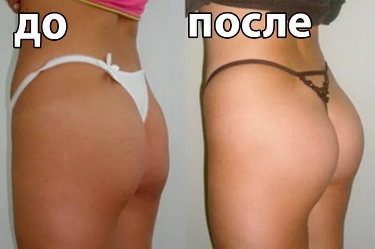 пластика ягодиц глютеопластика. пластика ягодиц глютеопластика. глютеопластика ягодиц. липофилинг ягодиц операция. липомоделирование ягодиц.