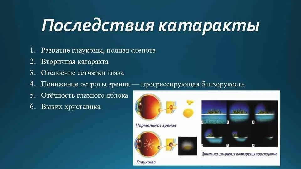 Осложнения при катаракте. Полная слепота это минус сколько. Годовой градиент прогрессирования миопии. Описание вторичной катаракты.