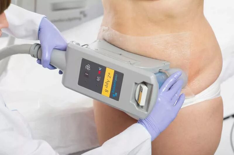 Что делать после криолиполиза. Криолиполиз Cryolipolysis 360. Аппарат Зелтик криолиполиз. Zeltiq криолиполиз. Криолиполиз RL G 03'.