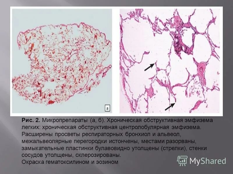 Тест эмфизема легких. Лучевая диагностика эмфиземы легких. Вдох при эмфиземе легких. Ацинарная эмфизема легких. Тест эмфизема легких.