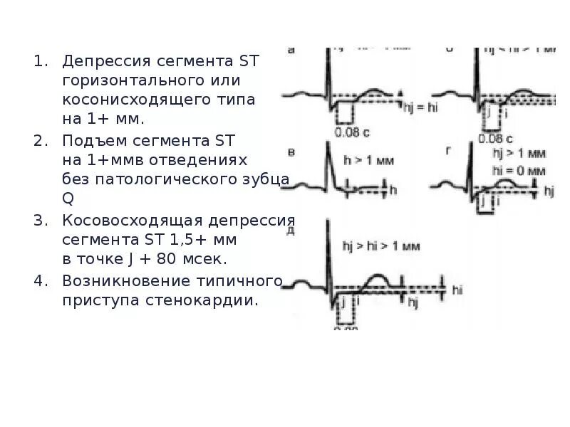 Косонисходящая депрессия сегмента. Подъем и депрессия сегмента st на экг. депрессия сегмента st на экг v5 v6. отведение v6 депрессия st. депрессия сегмента st на экг типична для.