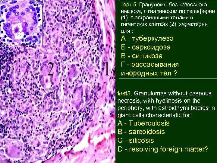 Ревматическая гранулема ашоффа талалаева. Саркоидная гранулема гистология. Туберкулезная гранулема рисунок. Зоны гранулемы. Эпителиоидноклеточные гранулемы.