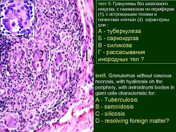 Эпителиоидноклеточные гранулемы. Гранулема строение гистология. Казеозный некроз гистология. Саркоидная гранулема гистология. Саркоидная гранулема