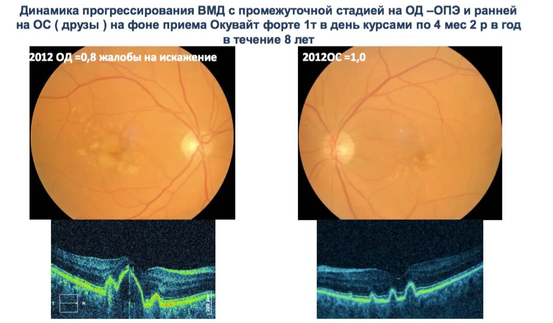 Лечение дегенерации макулы. Макулодистрофия друзы. Макулярная дегенерация сетчатки глаза. Возрастная макулярная дистрофия друзы. Возрастная макулодистрофия сетчатки.