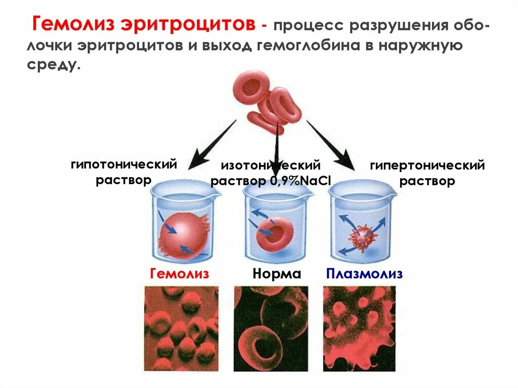 Место разрушения клеток крови. Этапы гемолиза эритроцитов. Гемолиз разрушение эритроцитов. Причины осмотического гемолиза эритроцитов. Гемолиз эритроцитов происходит в растворе.