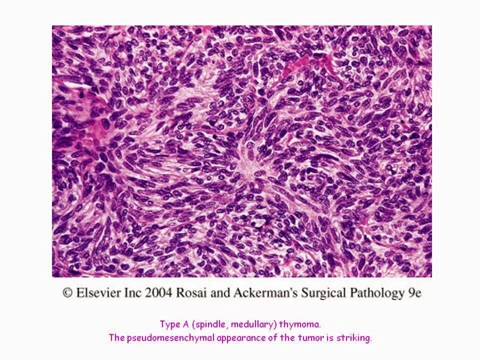 Герминома. Тимома гистологическая картина. Тимома классификация. Гистология тимома в типа.