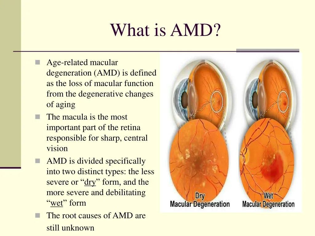 Types of Macular Degeneration. Age related Macular Degeneration Dry form.