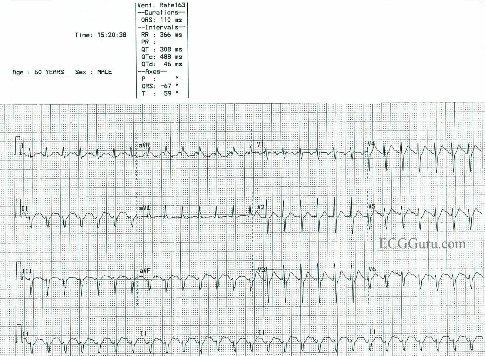 Тахикардия qrs. Предсердная тахикардия. синус тахикардия ecg. ventricular tachycardia на экг.