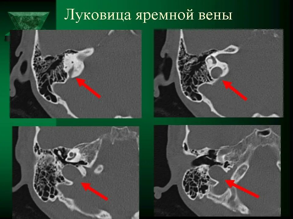 Расширение яремной вены. Анатомия височной кости кт. Луковица яремной вены на кт височных костей. Кт анатомия сосцевидного отростка. Предлежание сигмовидного синуса на кт.