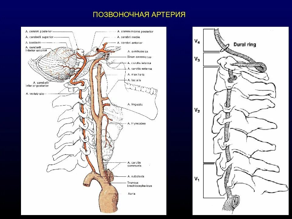 Сегмент v1 позвоночной артерии. Сегменты v1 v2 позвоночных артерий. V5 сегмент позвоночной артерии. Сегменты позвоночных артерий схема.