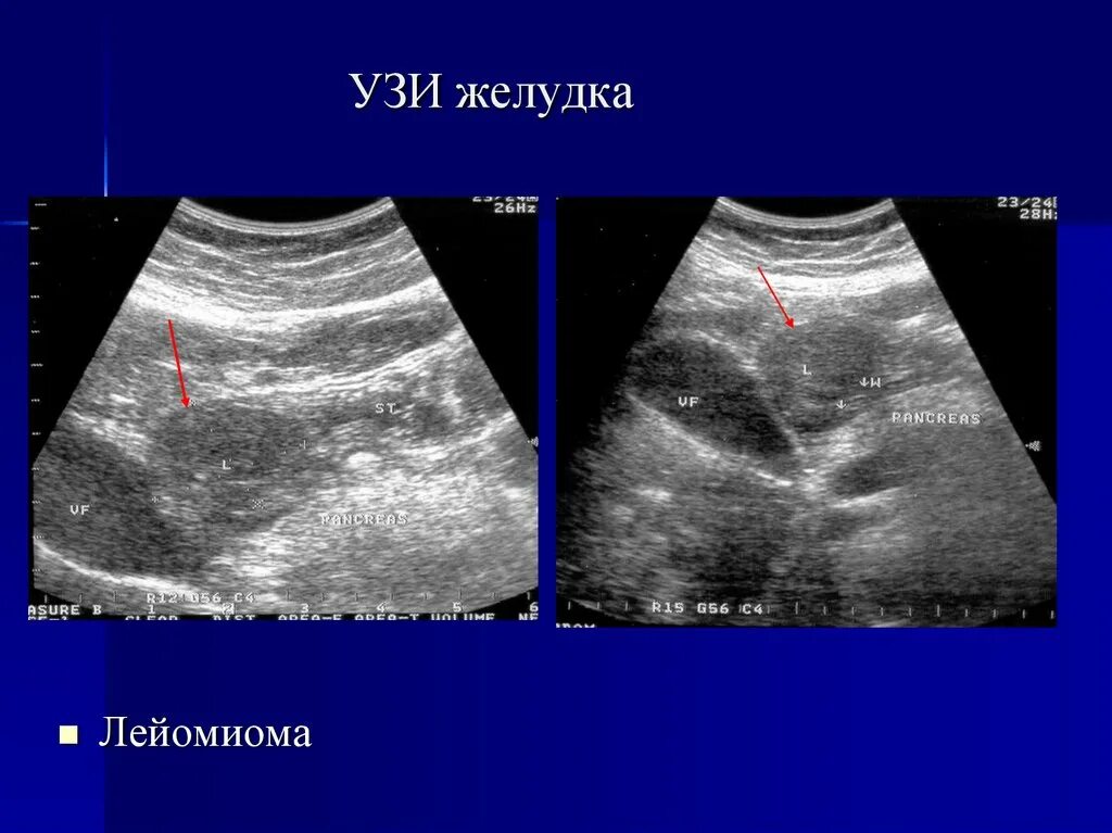 Опухоль желудка эхограмма. Желудок на УЗИ брюшной полости. Видна ли опухоль на узи