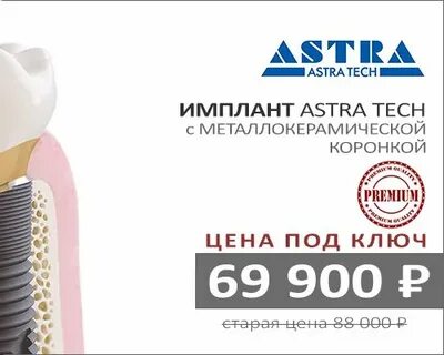 Astra имплант отзывы