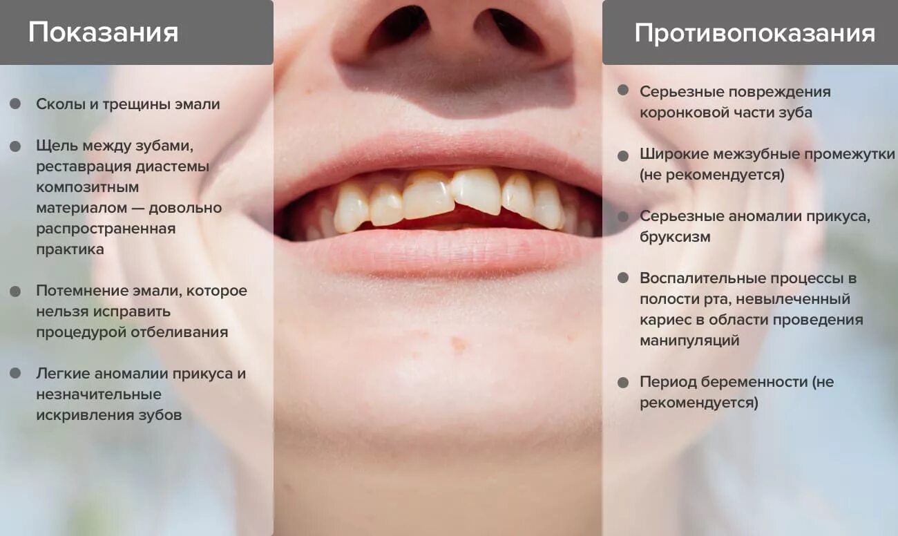 Показания и противопоказания к проведению композитной реставрации.. Виниры противопоказания. Виниры показания и противопоказания. Показания и противопоказания композитных материалов.