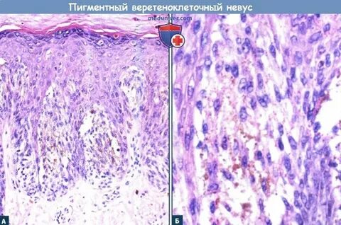 Гистология родинки