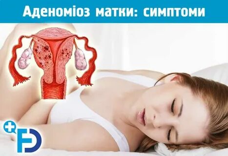 Аденомиоз это у женщины простыми словами