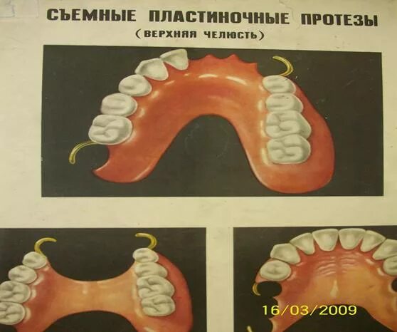 Границы пластиночного протеза. Границы базиса пластиночного протеза. Границы съемного протеза. Границы базиса съемного пластиночного протеза. Границы базиса протеза на нижней челюсти.