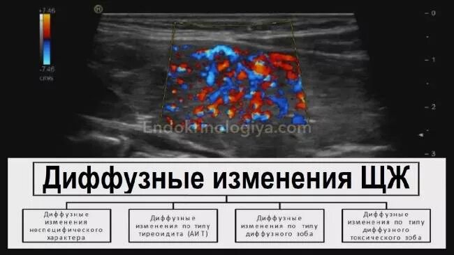 Диффузные изменения простыми словами. Паренхимы щитовидной железы на узи. узи картина диффузных изменений щитовидной железы. диффузно-очаговые изменения щитовидной железы узи. ультразвуковые признаки диффузных изменений щитовидной железы.