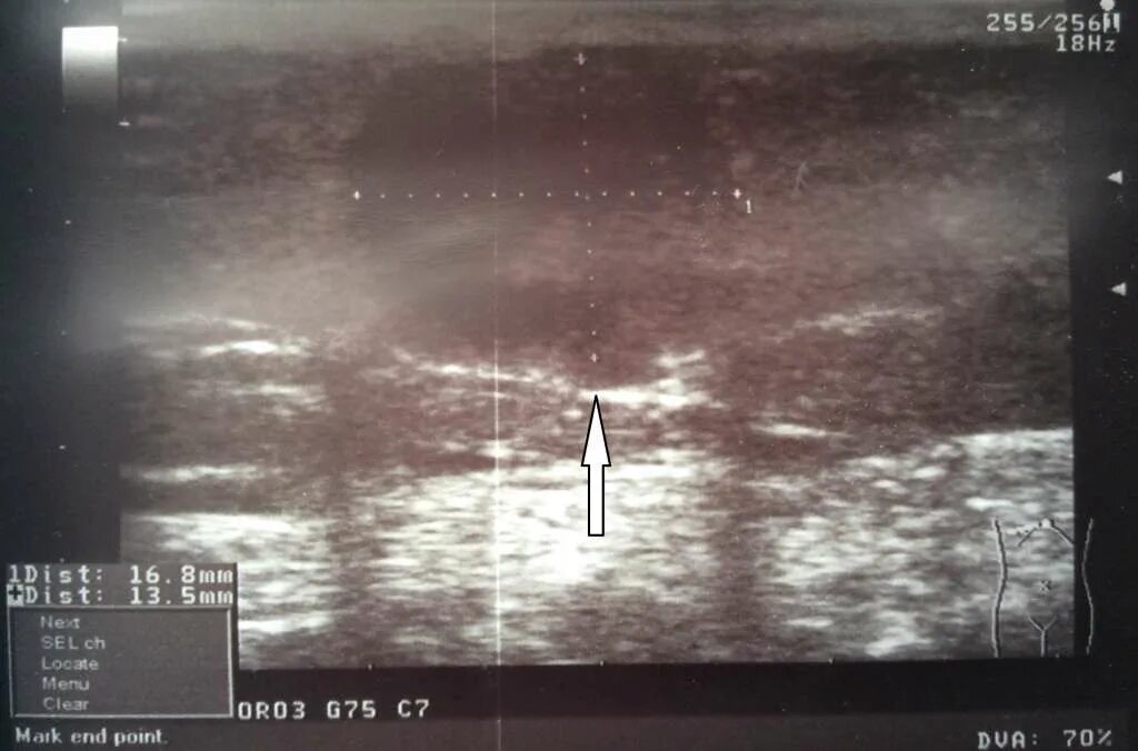 Подчелюстная слюнная железа на узи. Узи картина липомы мягких тканей. Киста подчелюстной слюнной железы на узи. Атерома молочной железы узи. Атерома на узи как выглядит.