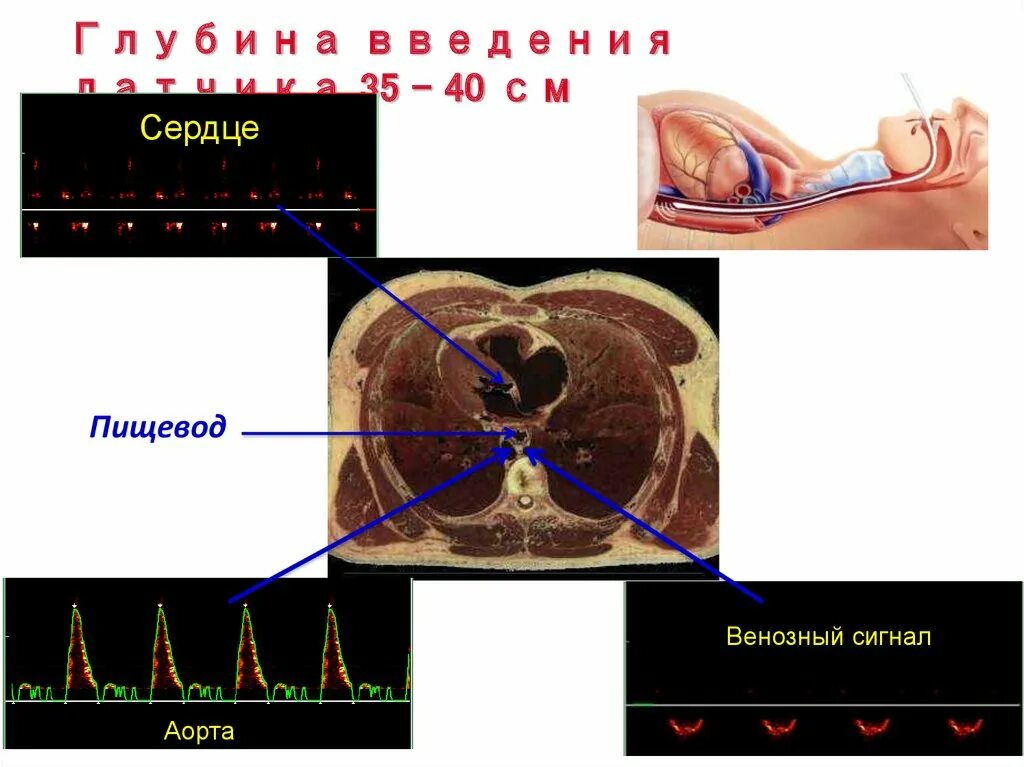 Мониторинг центральной гемодинамики. Через пищеводное УЗИ сердца. Эхокардиография сердца пищевод.