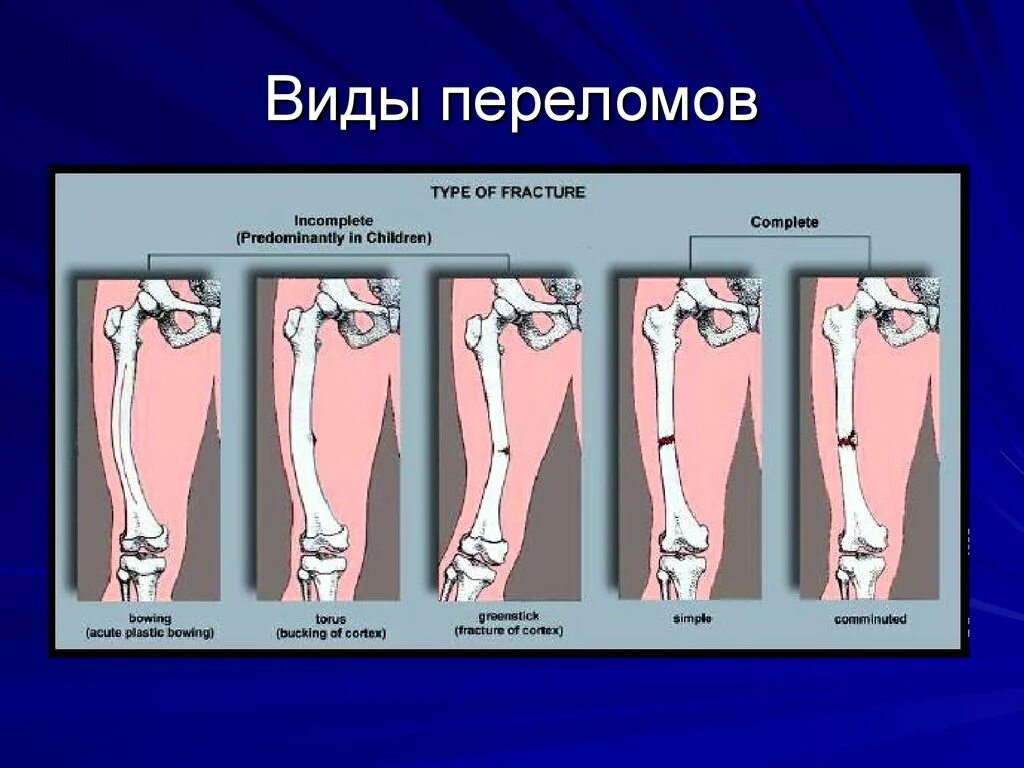 Степени открытого перелома. Типы закрытых переломов.