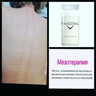 Сосудистый этап в мезотерапии