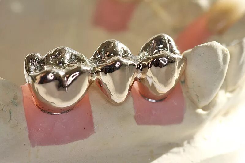 Цельнолитые мостовидный протез. Коронка цельнолитая (никель хром). Мостовидные протезы металл цельнолитые. Коронка цельнолитая (сплав remanium). Конструкции с литыми коронками.